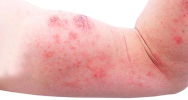 Atopic Dermatitis