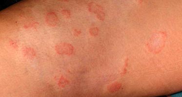 Fungal Infections