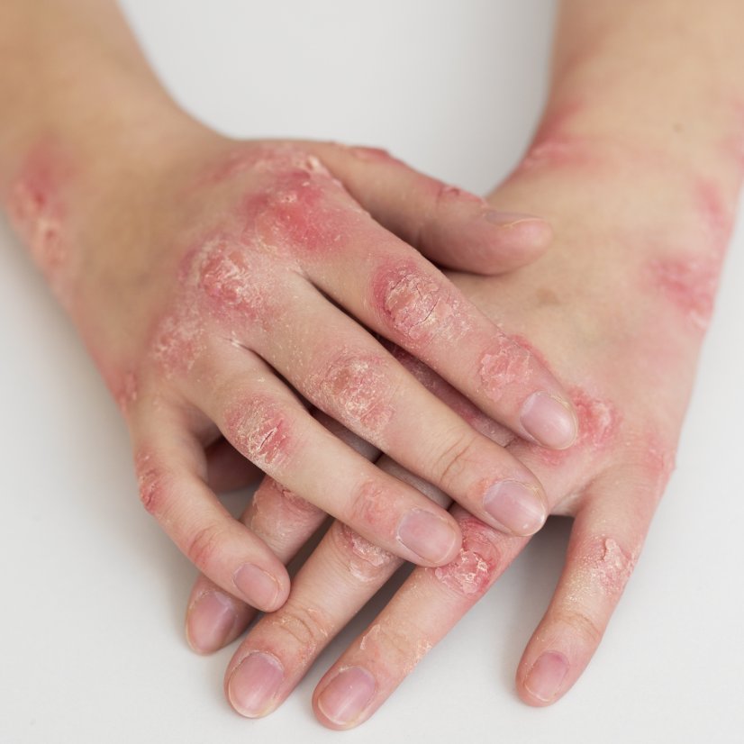 Eczema