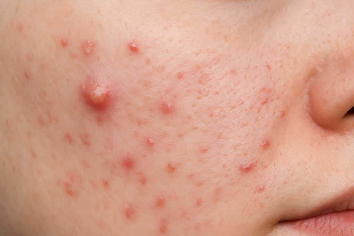 Pimples